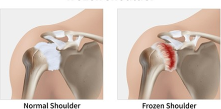Anatomy comparison of a normal shoulder joint and a frozen shoulder with an inflamed, thickened capsule